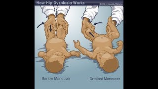 #Barlow and #Ortoalani signs-DDH#CongenitalHipDislocation!!!!