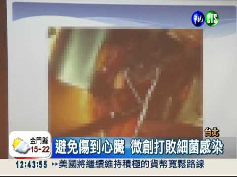 裝心律器染菌 微創手術開心救命