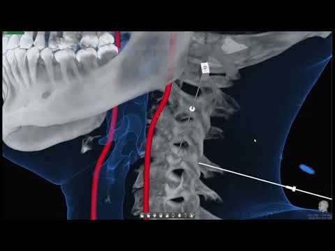 NewTom 7G - Periradikuläre Therapie (PRT) der HWS