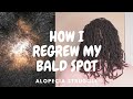 How I Regrew My Bald Spot Alopecia And Locs 2023