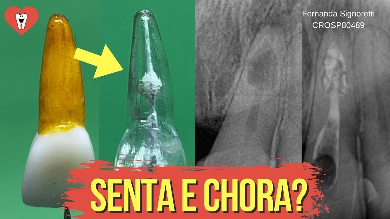 ENDODONTIA EM REABSORÇÃO INTERNA - PASSO A PASSO - Endolovers