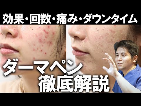 「ダーマペン」と「ダーマローラー」の効果と違いについて | 公式コラム | 美容整形・二重整形なら共立美容外科