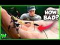 BITTEN By A BANANA SPIDER