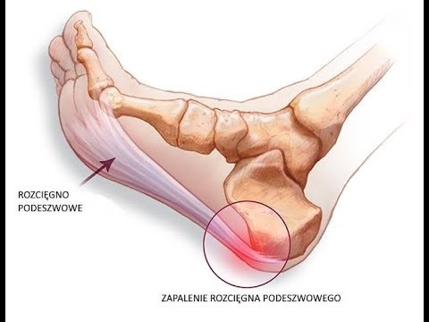 Jak usunąć guzek w stawu palucha Opony koślawego hallufix zdjęcie