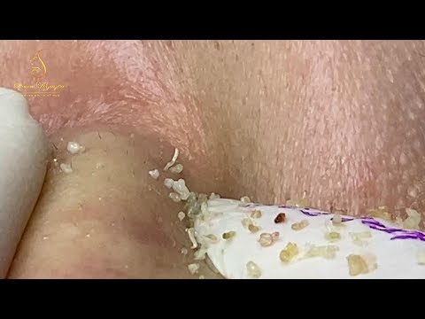 Loan Nguyen Acne Treatment (#128)