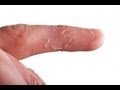 DermTV - Very Itchy Fingers, a.k.a. Dishydrosis ...