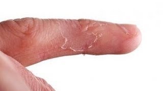 DermTV - Very Itchy Fingers, a.k.a. Dishydrosis [DermTV.com Epi #396]