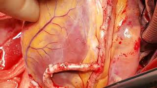 Dr. Viacheslav Bobovnikov Heart Procedure