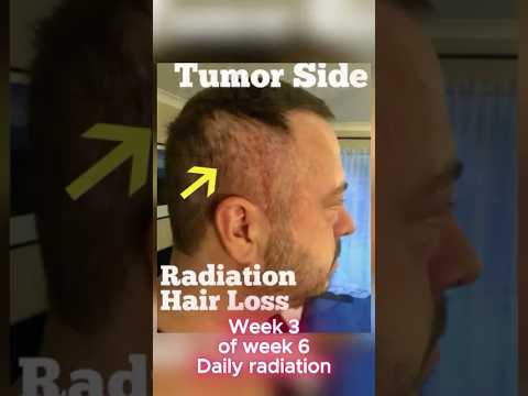 Before & After: Hair Loss Transformation from Radiation! #radiation