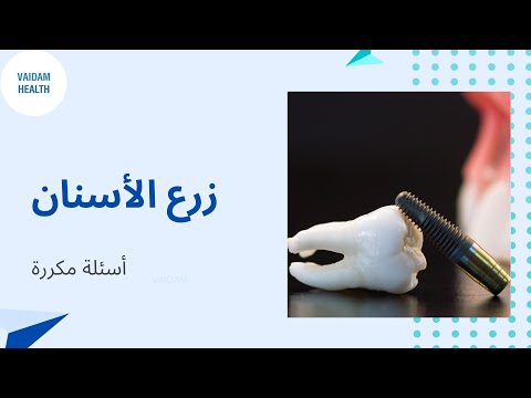 الأسئلة المتداولة حول زراعة الأسنان