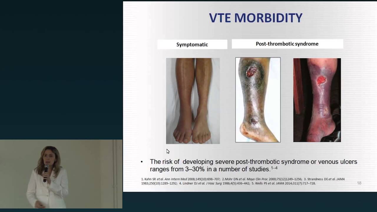 Dra. Ludhmila Hajjar - Atualização em Tromboembolismo Pulmonar: Fisiopatologia e Tratamento