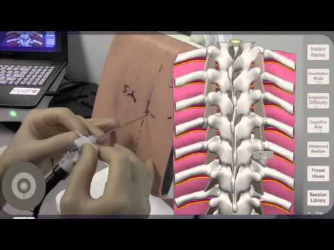 Needle Angulation For Thoracic Paravertebral Block Tpvb