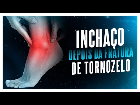 O QUE FAZER COM O INCHAÇO DEPOIS DA FRATURA DO TORNOZELO?