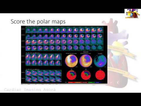 Step by Step Reading of a Cardiac PET for Scar or Hibernation Detection