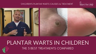 Plantar Warts in Children The 3 Best Treatments Compared