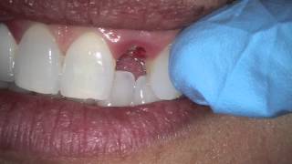 tooth sheared off at gum line
