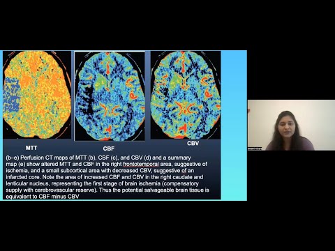 Swathi Kisara  - Ischemic Stroke Imaging