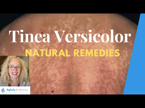 NATURAL HOME REMEDIES FOR TINEA VERSICOLOR