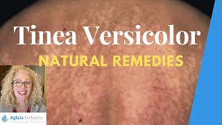 NATURAL HOME REMEDIES FOR TINEA VERSICOLOR