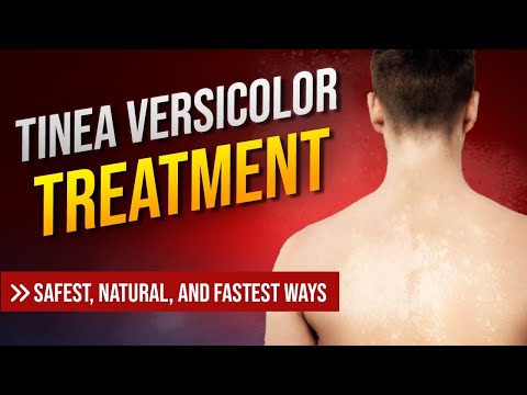 Treatment of Tinea Versicolor - Safest, Natural, and Fastest Ways