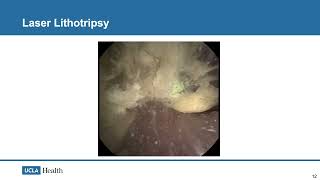 Core Videos (2024): Basics of Ureteroscopy with Laser Lithotripsy
