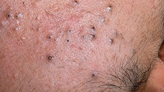 Blackhead Removal & Deep Facial Cleansing | Korean Skin Care