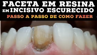 🛑FACETA EM RESINA COMPOSTA EM INCISIVO ESCURECIDO: PASSO A PASSO NA PRÁTICA ( CORES, PIGMENTOS...)🎯🤫