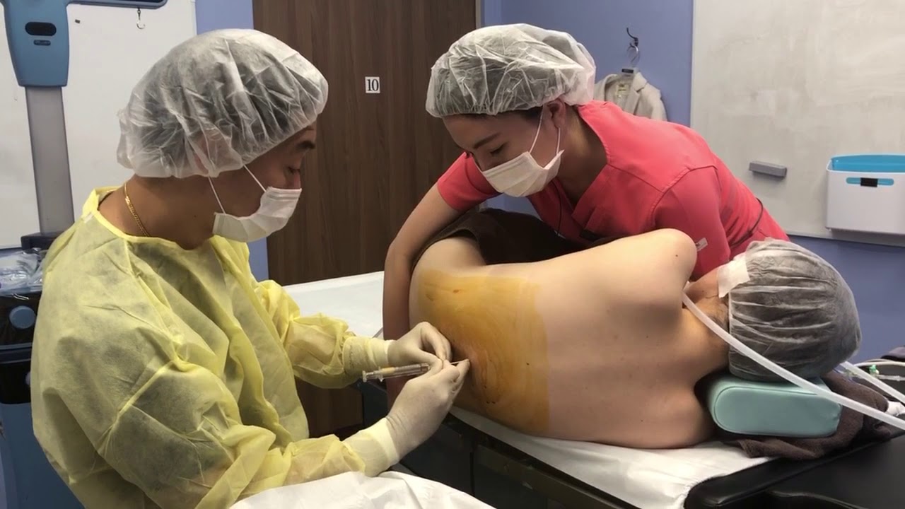 リピーターの患者様！社会人になって５kg太ったのでおなかの脂肪吸引を受ける！術中劇的変化