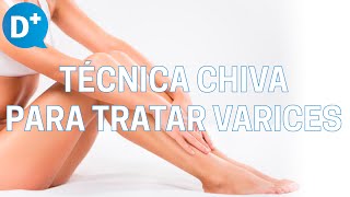 Técnica Chiva para tratar Varices