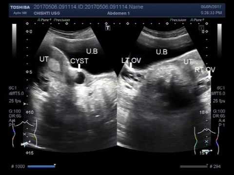 Ultrasound Video showing a large cervical cyst.