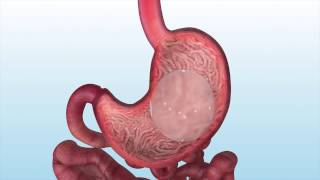 Orbera Non-Surgical Gastric Balloon Placement