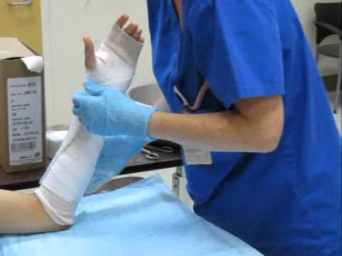 Radial Gutter Splint