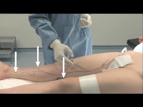 varicoza sfaturi folclorice varicoza anestezie epidurala