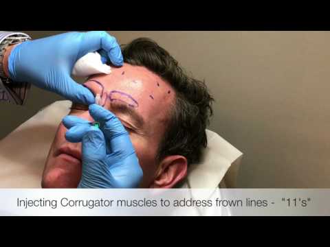 image-How do you release a corrugator muscle?