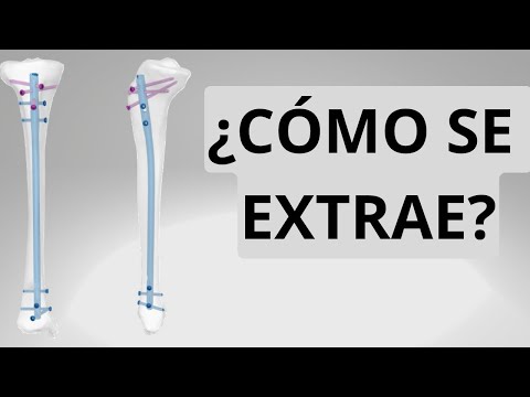 CLAVO DE TIBIA ¿COMO SE SACA?