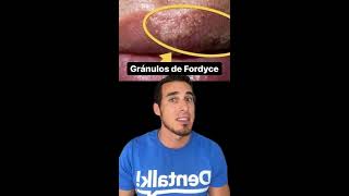 ¿Tienes estos GRANITOS en los LABIOS o GENITALES Aquí te explico qué es - Fordyce
