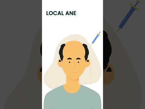 Complete FUE Hair Transplant Process...