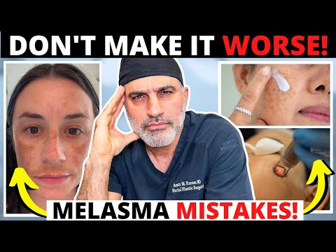 Melasma mistakes that can ruin your skin and make hyperpigmentation worse!