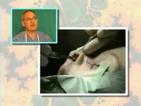Estetska operacija nosa, nose surgery Dr. Glusac