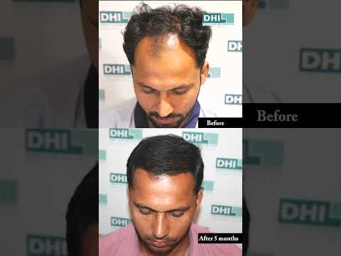 Hair Transplant Results | Transform Your Hair with DHI