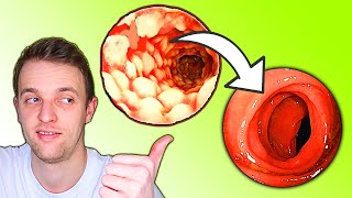 The Quickest Way to Escape a Flare of Ulcerative Colitis