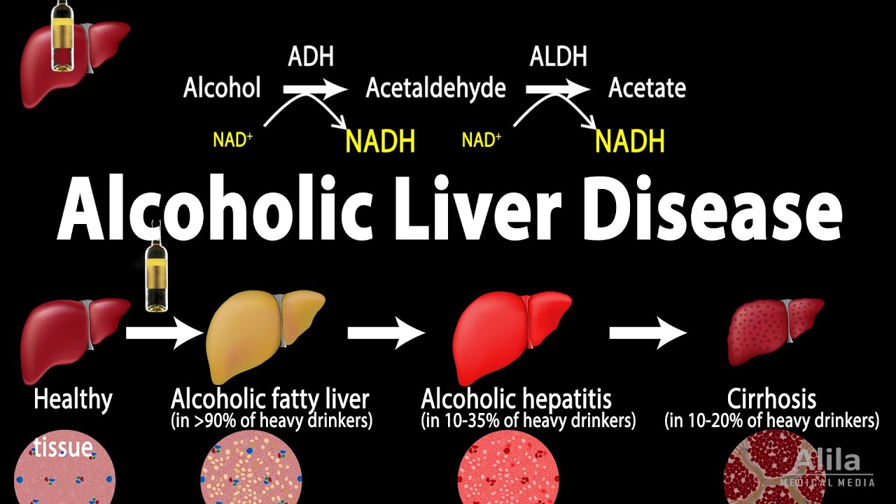 Impact Of Alcohol Consumption On Liver Health Over Time Impact Of Alcohol Consumption On Liver Health Over Time