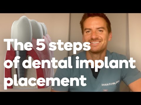 The 5 Steps of getting a dental implant