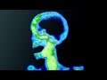 A Man Ate Only Instant Noodles For 6 Months This Is What Happened To His Organs