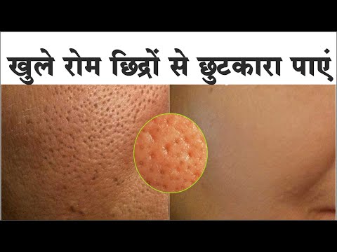 चेहरे के रोम छिद्र को 3 दिन में हमेशा हमेशा के लिए खत्म करें | close open & Large pores permanently