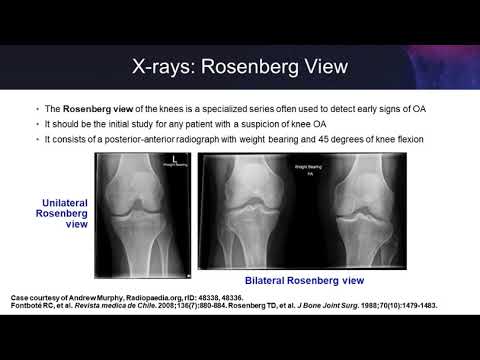 térd osteoarthritis kezelése ózonnal