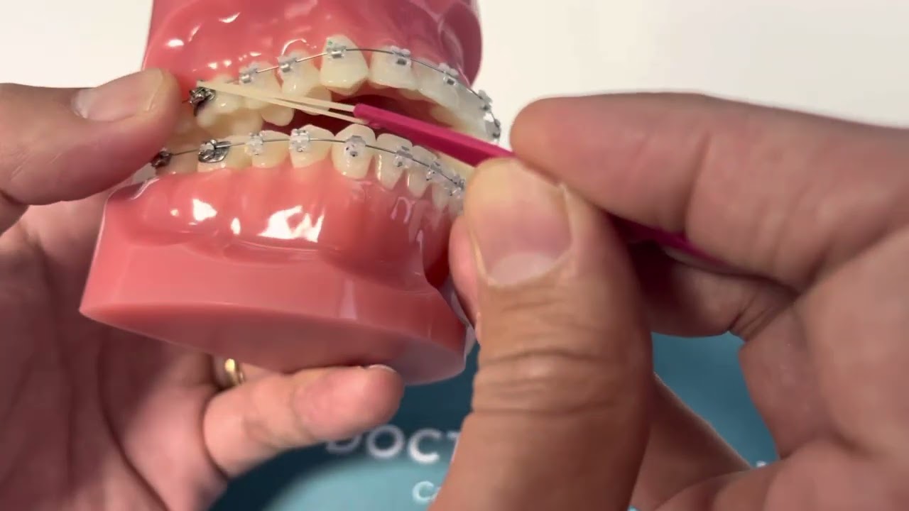 Port des élastiques en TIM 3