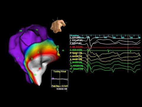 Cavo tricuspid Isthmus for atrial flutter. #cardiacelectrophysiology #epstudy