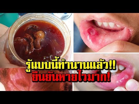 ปริมาณ methotrexate ในโรคสะเก็ดเงิน ฉันหาย neurodermatitis ด้วยการเดินเท้า