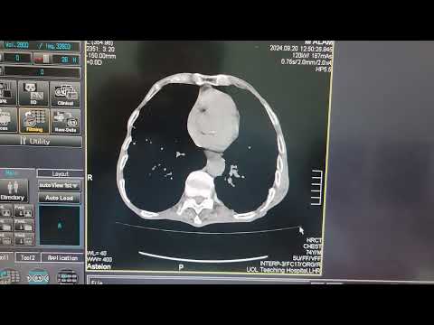 Emphysema on CT
